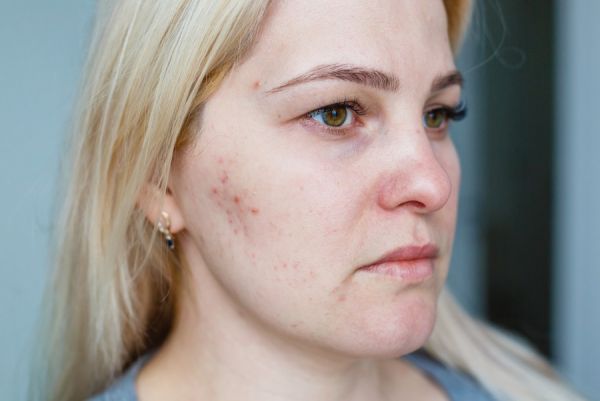 Avez-vous déjà eu de l'acné ?
