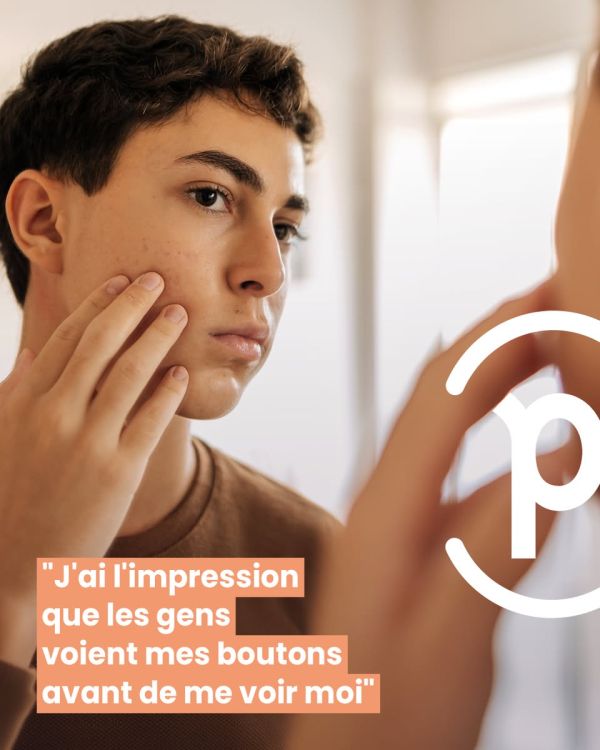 #ACNÉ | Ce n'est pas qu'une histoire de boutons... 🔴